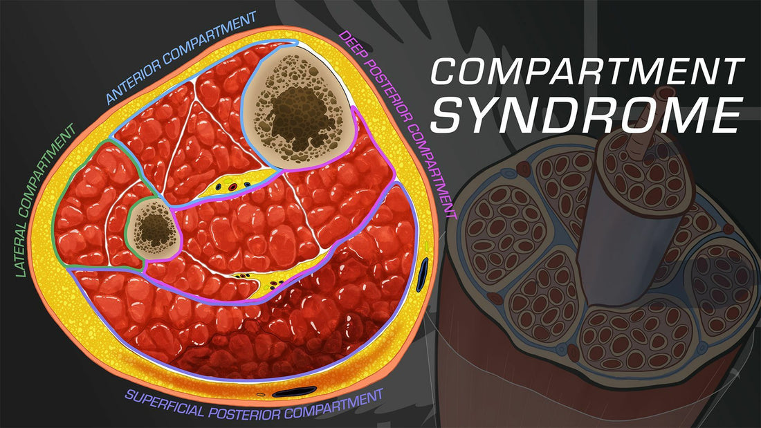 El Síndrome Compartimental