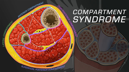 El Síndrome Compartimental
